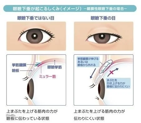 眼瞼下垂が起こるしくみ